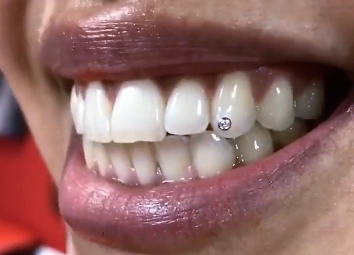 Smile Gallery – Swarovski Tooth Crystals & Tooth Jewelry