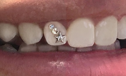Smile Gallery – Swarovski Tooth Crystals & Tooth Jewelry